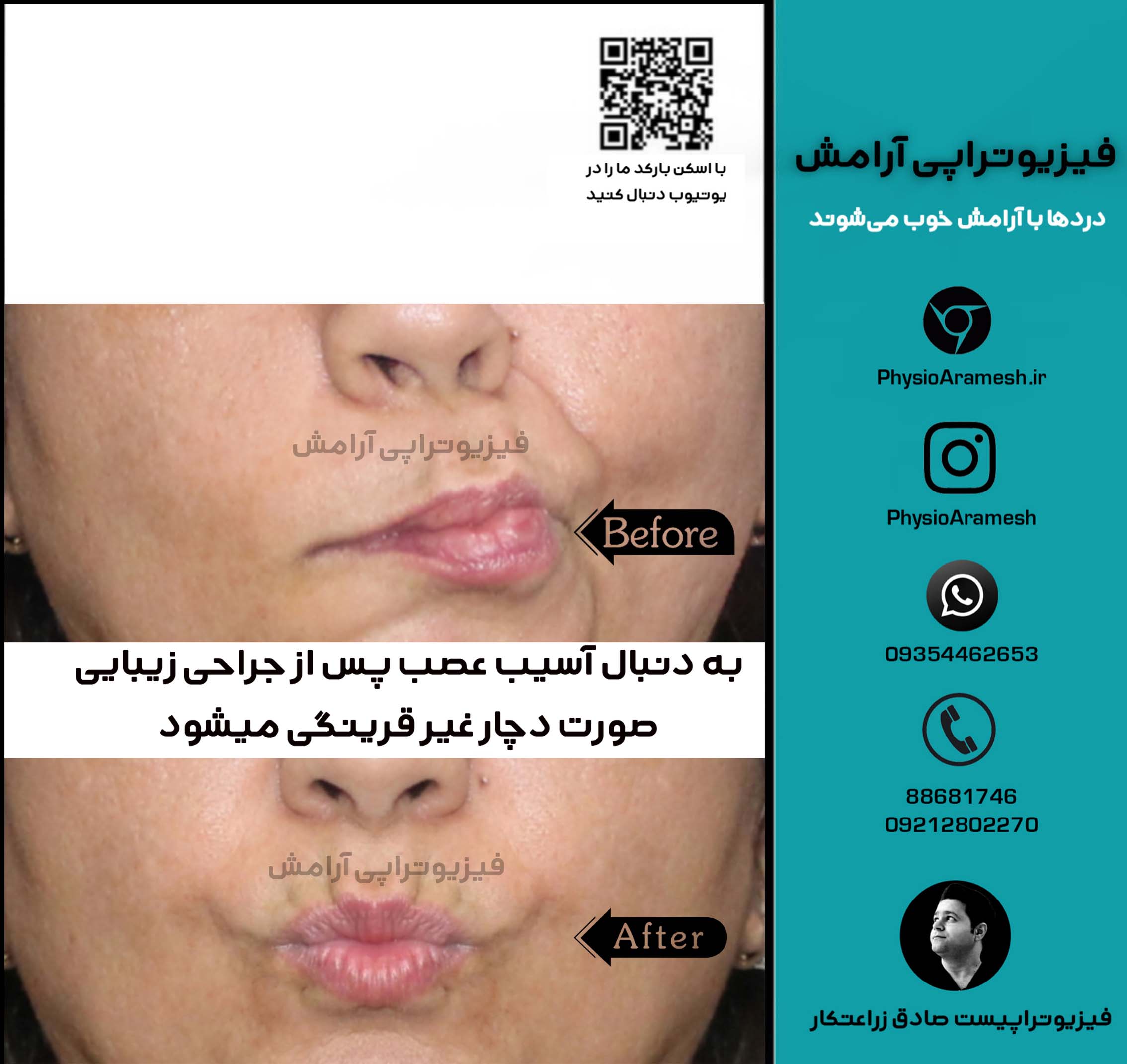 درمان آسیب عصب صورت